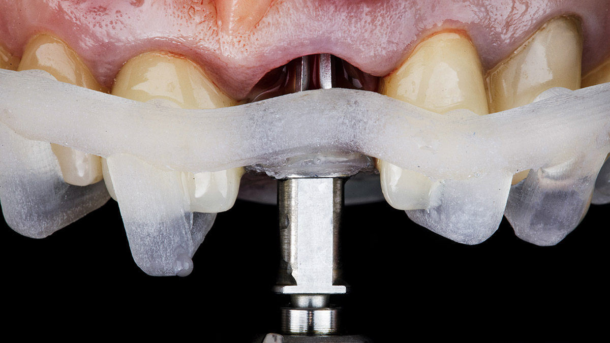 Impianti dentali Studio Odontiiatrico Cafaro