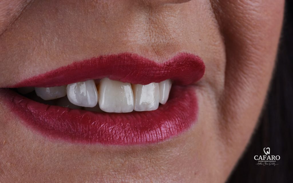 Quando è necessario mettere le faccette dentali? Tutto quello che c’è da sapere, dai vantaggi ai Quando è necessario mettere le faccette dentali? Tutto quello che c’è da sapere, dai vantaggi ai